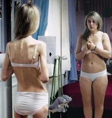 anorexia-2.jpg